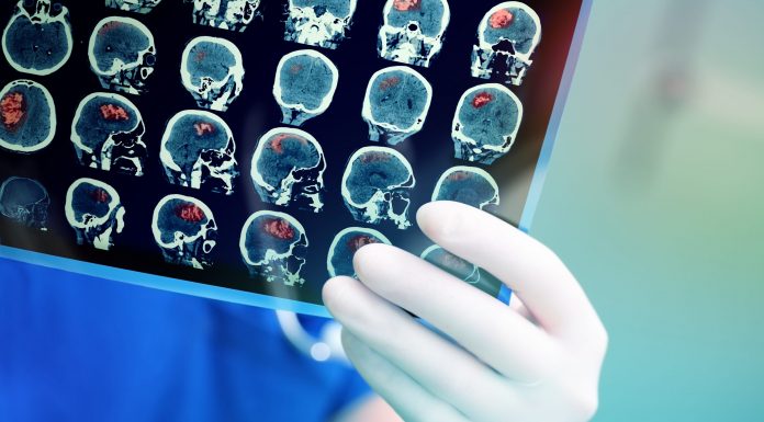 Mekanisme Stroke Iskemik