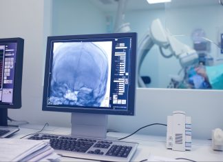 Peran Neurointervensi Pada Stroke Akut