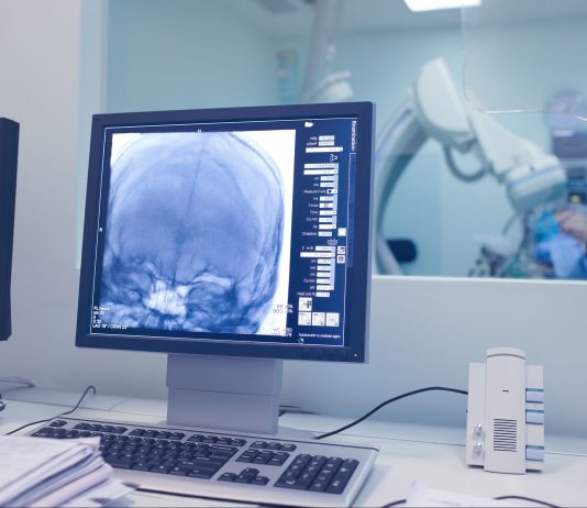 Peran Neurointervensi Pada Stroke Akut